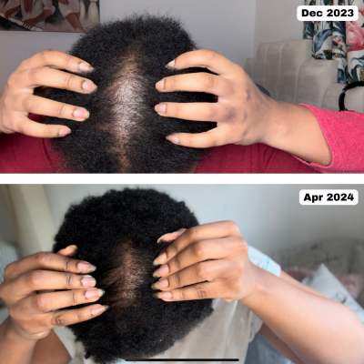 Hair growth progress